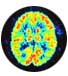 Borderline Personality Disorder is in the brain